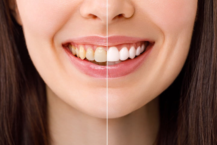 Teeth Whitening Prices Turkey In Istanbul Alyans Clinic