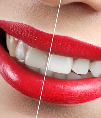 Teeth Whitening Prices Turkey In Istanbul Alyans Clinic