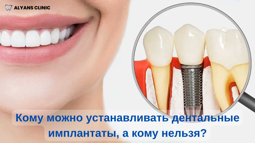 komu-mozhno-ustanavlivat-dentalnye-implantaty-a-komu-nelzya