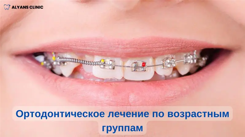 ortodonticheskoe-lechenie-po-vozrastnym-gruppam