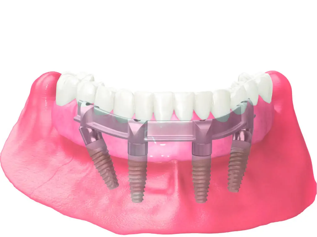 all-on-4-implant-alyansclinic