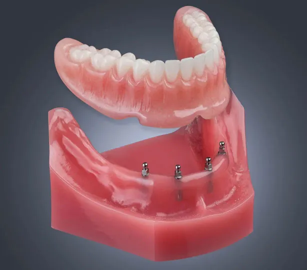 mini-implant-alyansclinic