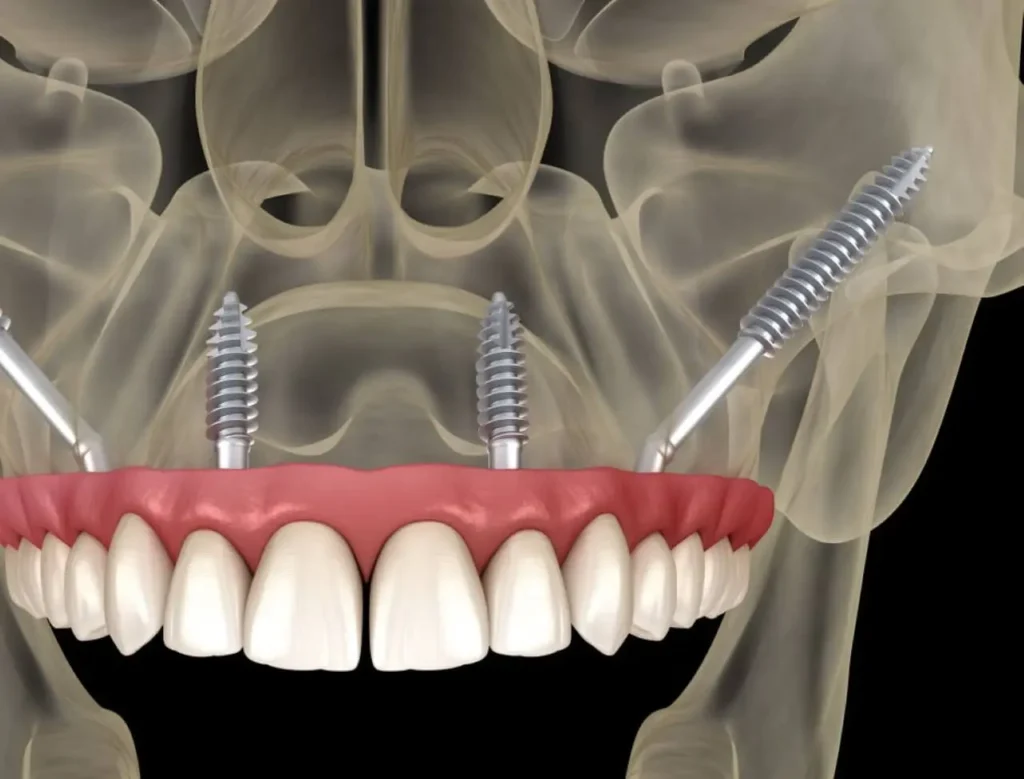 zigomatik-implant-alyans-clinic