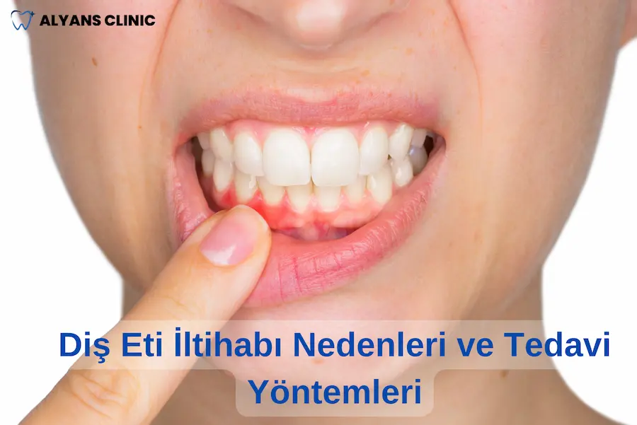 Diş Eti İltihabı Nedenleri ve Tedavi Yöntemleri