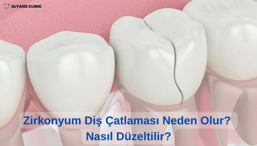 Zirkonyum Diş Çatlaması Neden Olur Nasıl Düzeltilir