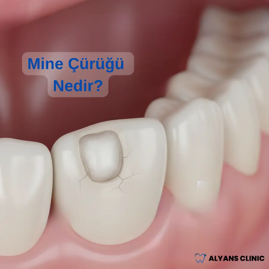 mine-curugu-nedir