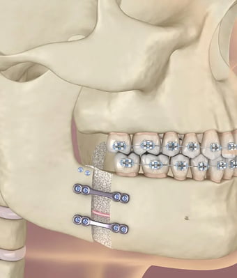 Jaw Surgery in Turkey | Orthognathic Surgery | Alyans Clinic