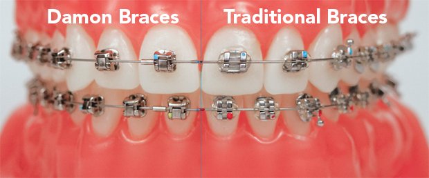 Types of Brackets and Their Uses - Alyans Clinic