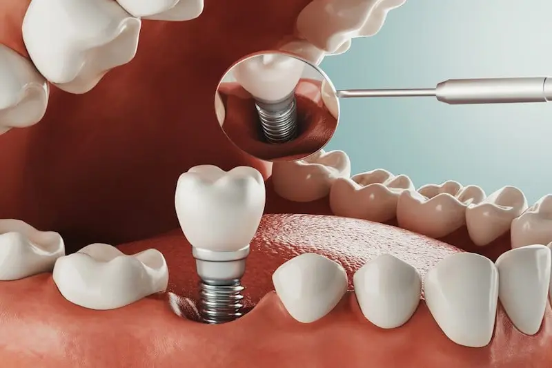 turkey-dental-implant-treatment