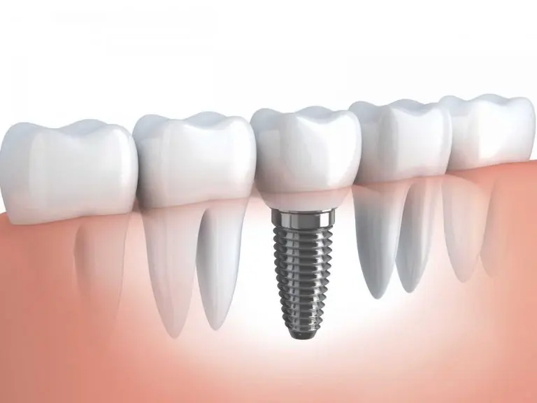 turkey-dental-implant