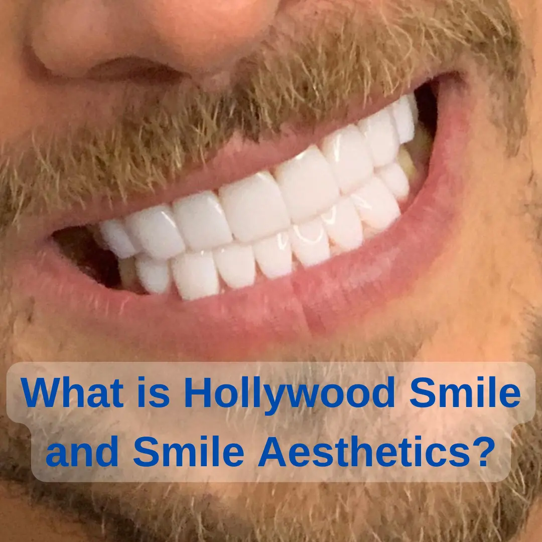 whats hollywood smile