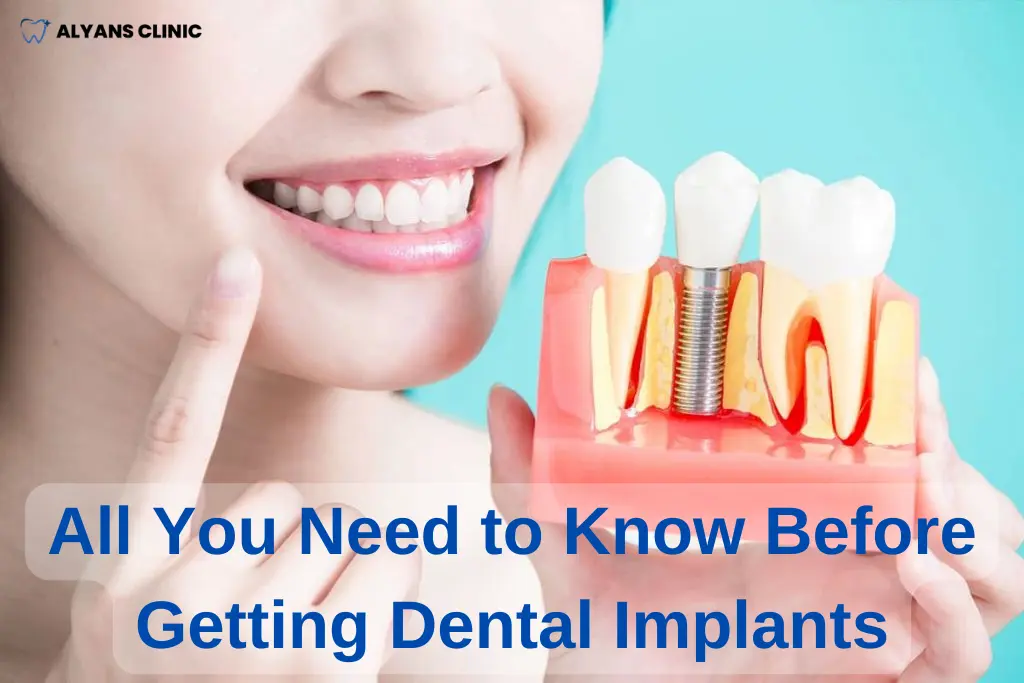 What You Need to Know Before Getting Dental Implants