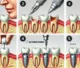 steps of dental implant